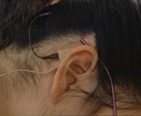 小伙丢失20万的人造耳蜗为何人造耳蜗如此昂贵人造耳蜗对失聪人士有多重要（北京地铁丢耳蜗事件）2